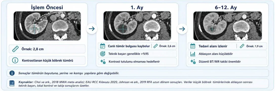 Böbrek tümör ablasyonu sonrası işlem öncesi, 1. ay ve 6-12. ay kontrol karşılaştırması