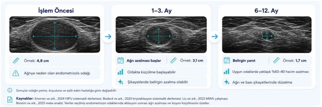 Endometriozis ablasyonu sonrası işlem öncesi, 1-3. ay ve 6-12. ay ultrason karşılaştırması