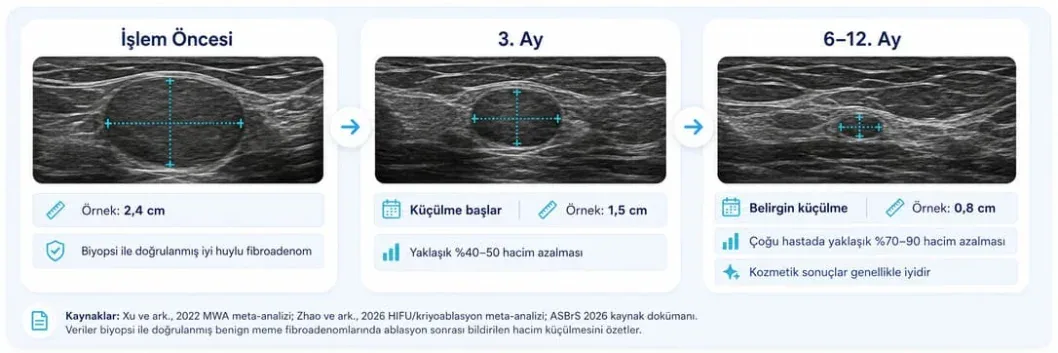Meme fibroadenom ablasyonu sonrası işlem öncesi, 3. ay ve 6-12. ay ultrason karşılaştırması