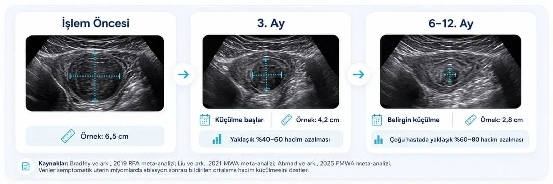 Miyom ablasyonu sonrası işlem öncesi, 3. ay ve 6-12. ay ultrason karşılaştırması