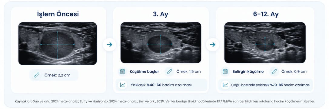 Tiroid nodül ablasyonu sonrası işlem öncesi, 3. ay ve 6-12. ay ultrason karşılaştırması