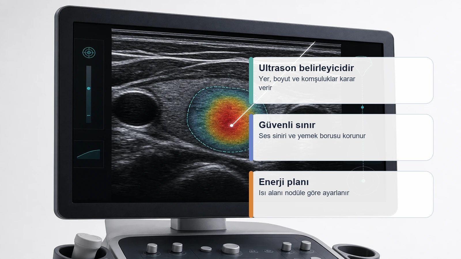 Tiroid nodül ablasyonunda ultrason ekranı üzerinde nodül hedefi ve güvenli ısı planını gösteren medikal görsel