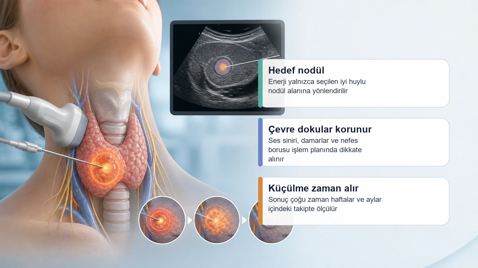 Tiroid Nodül Ameliyat mı Ablasyon mu? için tiroid nodül ablasyonunda probun nodül içinde kontrollü enerji etkisi oluşturduğunu anlatan premium medikal görsel