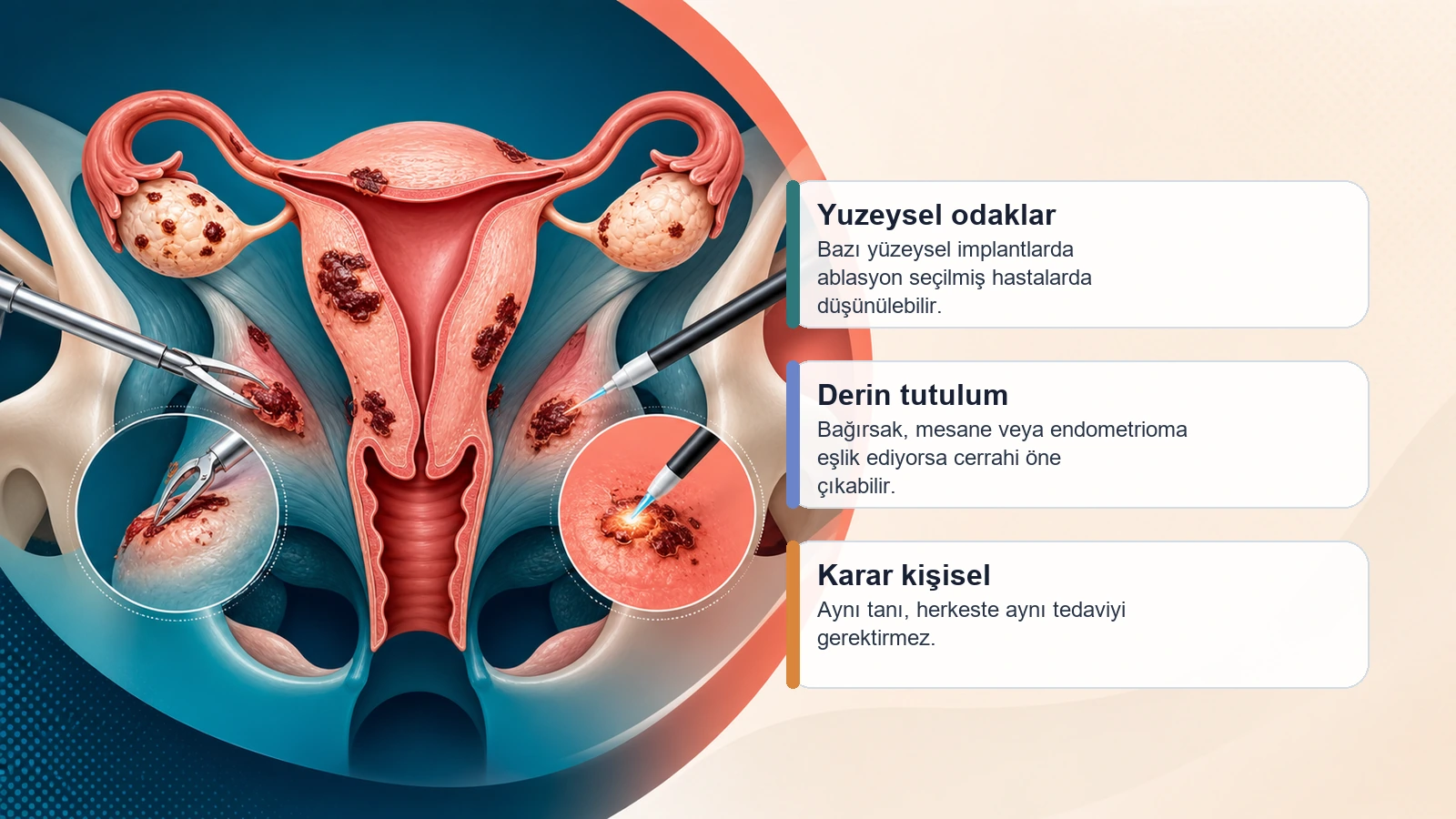 Endometriozis Ameliyat mı, Ablasyon mu? için endometriozis tedavisinde yüzeysel odaklar, derin tutulum ve kişiye özel karar sürecini açıklayan premium medikal görsel