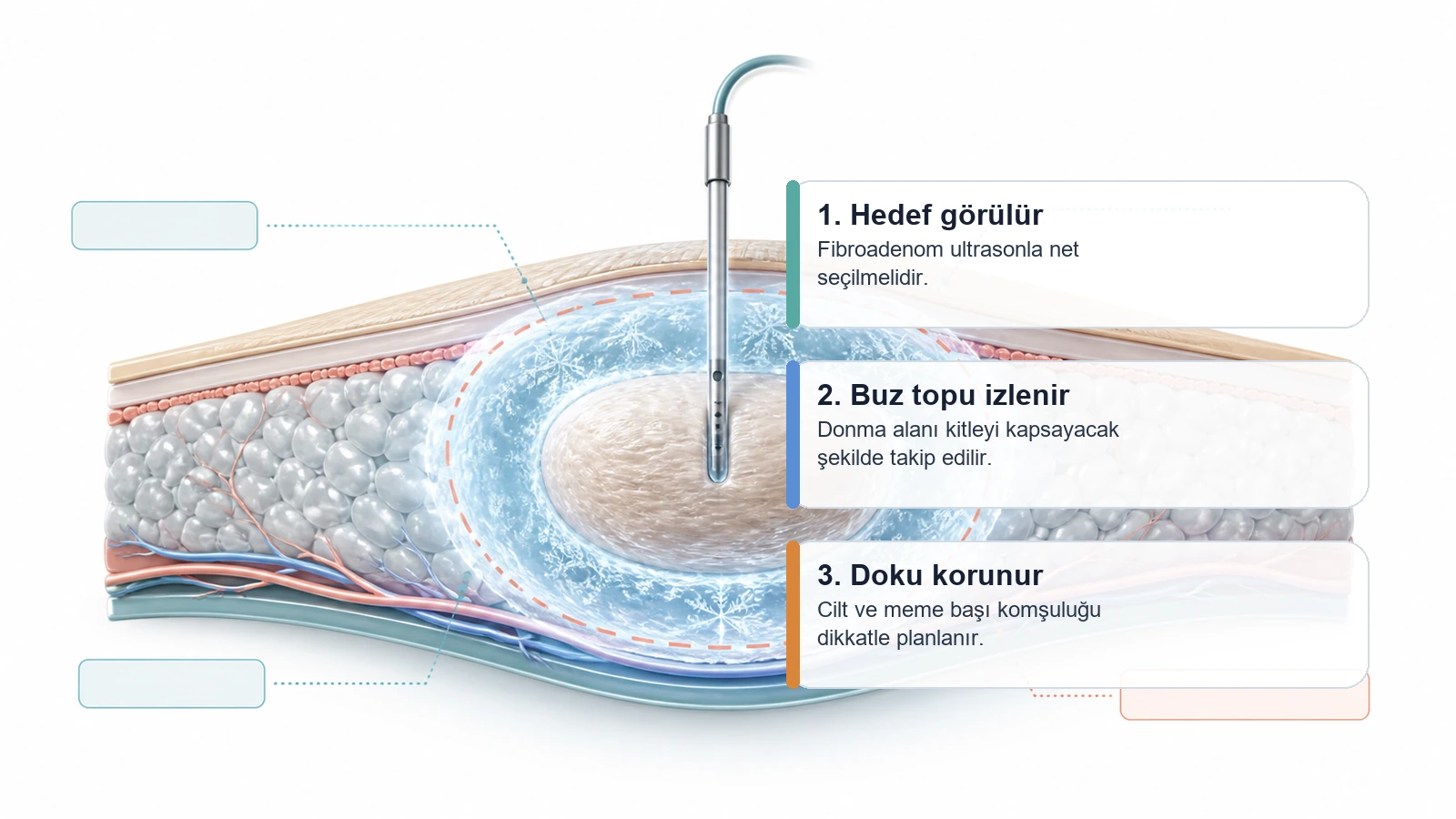 Fibroadenom kriyoablasyonda hedefin görülmesi, buz topunun izlenmesi ve çevre dokunun korunmasını anlatan premium medikal görsel