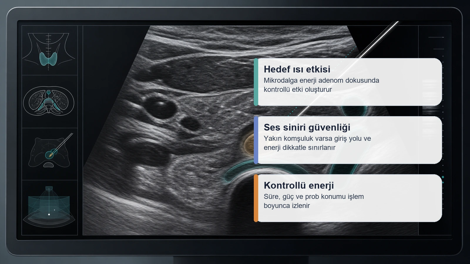 Paratiroid adenom mikrodalga ablasyonunda ultrason rehberliği ve ses siniri güvenliğini anlatan görsel