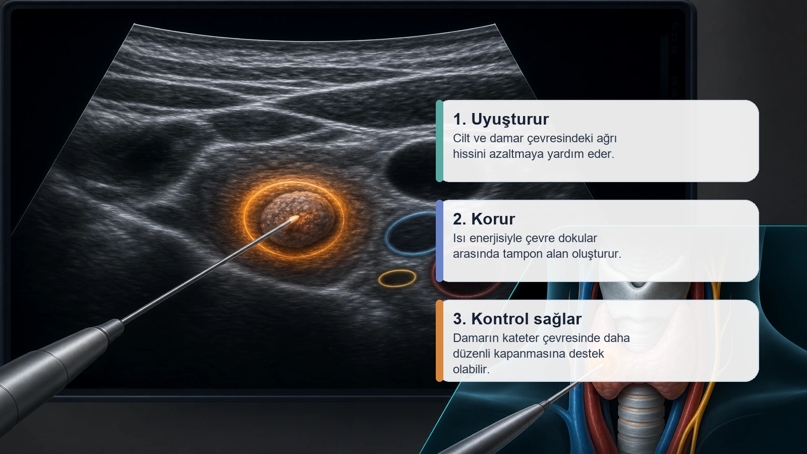 Paratiroid Adenom Radyofrekans Ablasyonu için tümesan lokal anestezinin damar çevresindeki etkisini açıklayan premium medikal görsel
