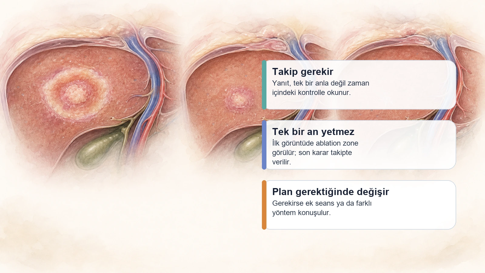 Radyofrekans, Mikrodalga ve Kriyoablasyon ile Tümör Tedavisi için zaman içindeki yanıt ve takip sürecini anlatan premium medikal görsel