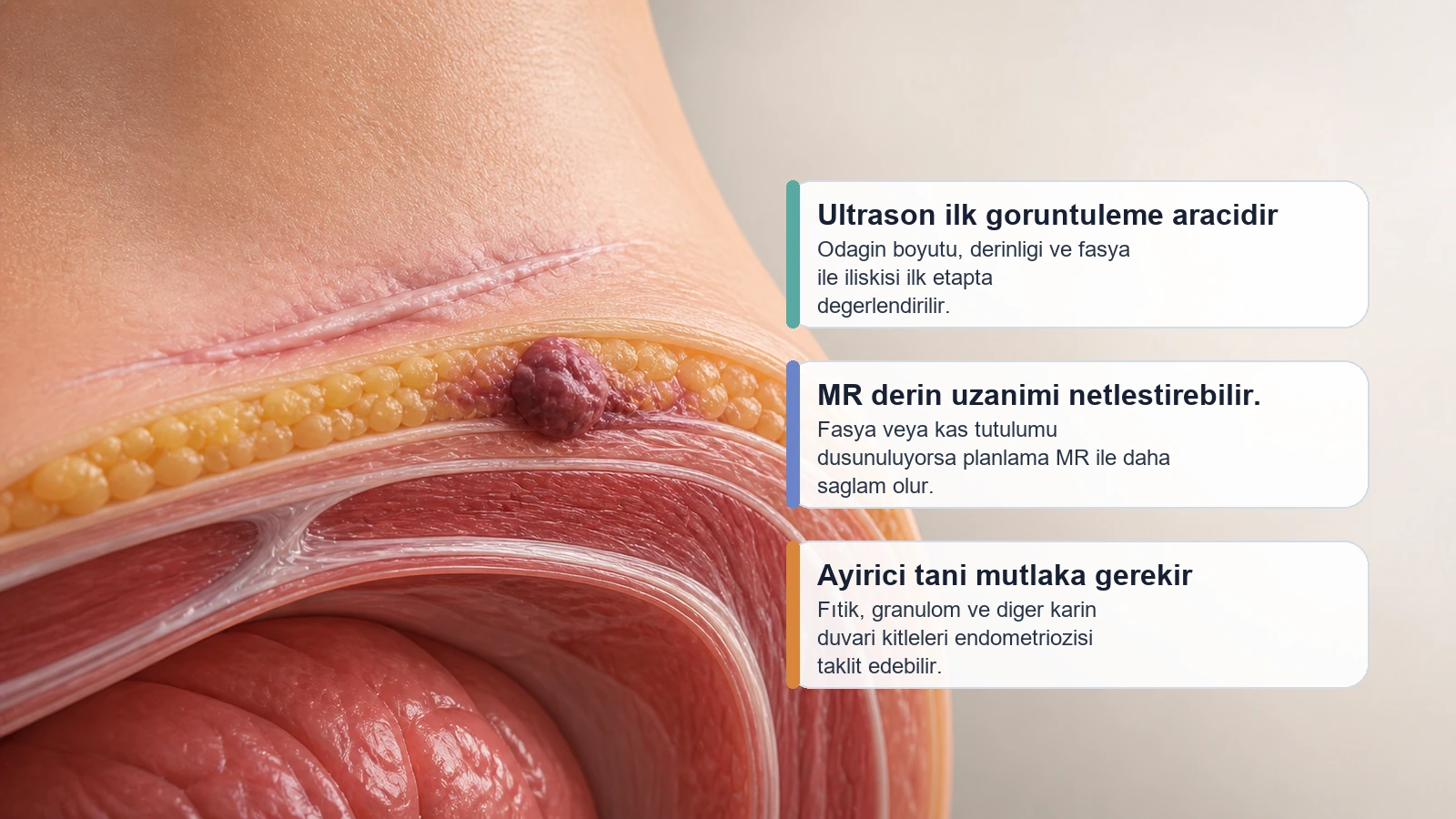 Sezaryen skarı endometriozisinde ultrason ve MR ile anatomik planlamayi anlatan premium medikal gorsel