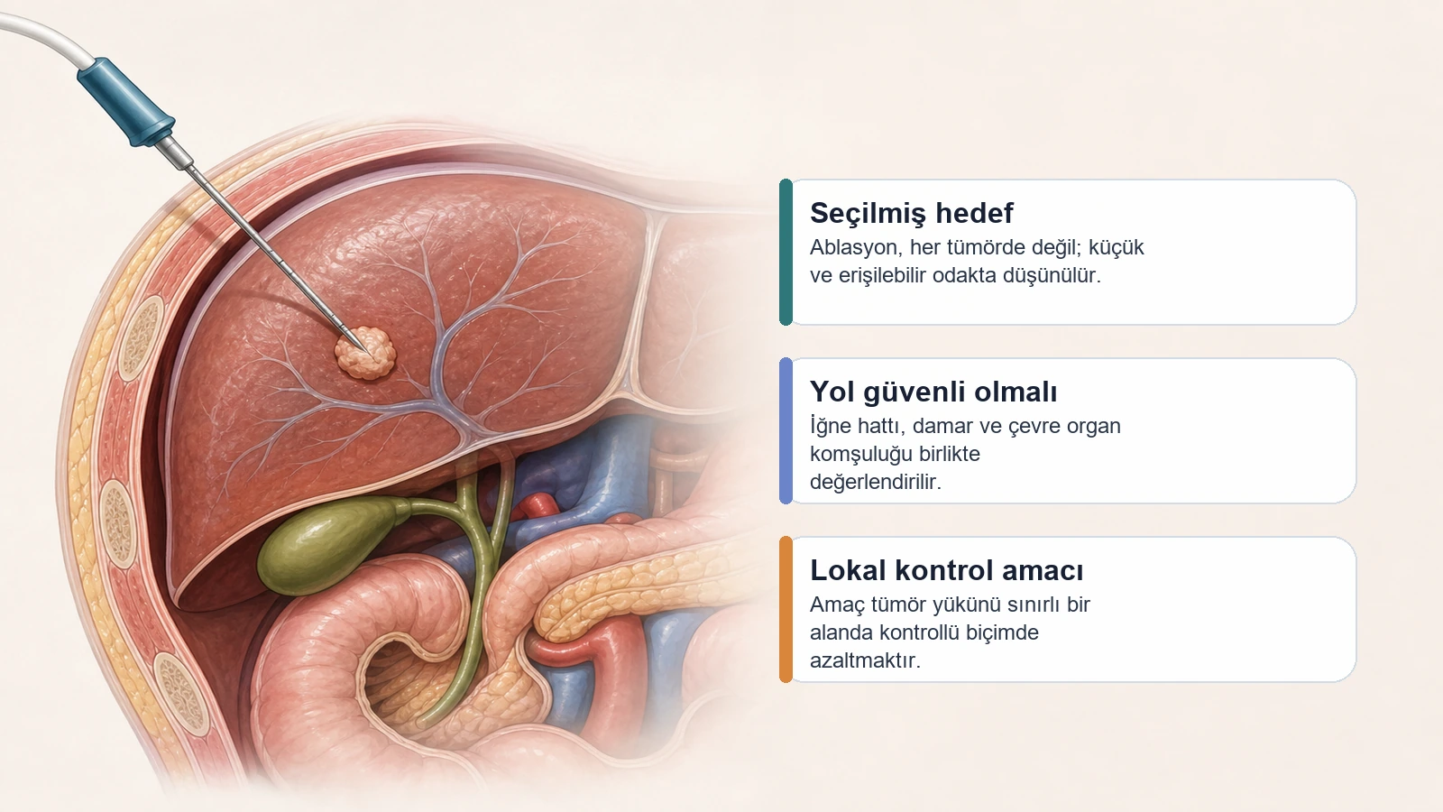 Tümör ablasyonu için seçilmiş, küçük ve erişilebilir bir karaciğer hedefinin perkütan ablasyonla tedavi edildiğini gösteren premium medikal illüstrasyon