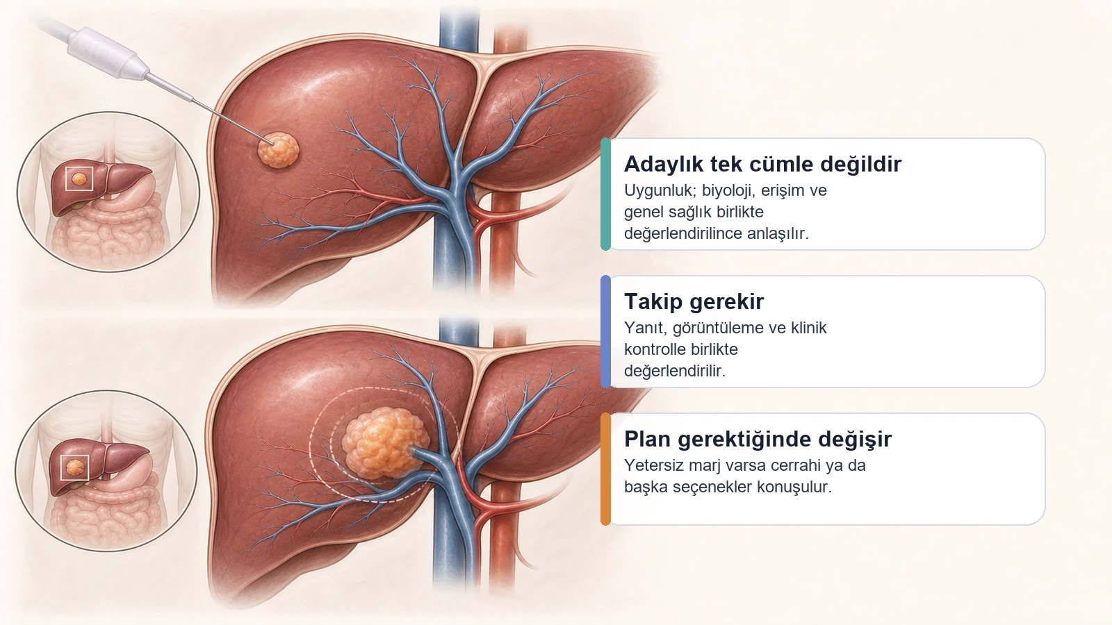Tümör ablasyonunda yanıtın zaman içinde izlendiğini anlatan karaciğer tedavi ve takip illüstrasyonu