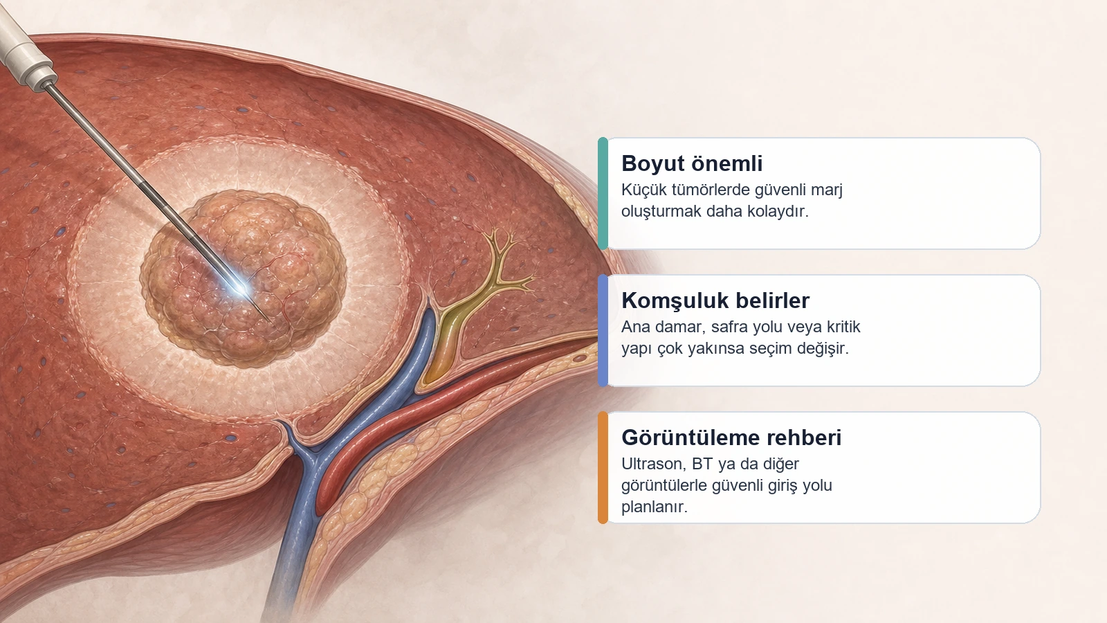 Tümör ablasyonunda boyut, damar komşuluğu ve güvenli giriş yolunu anlatan karaciğer anatomisi illüstrasyonu