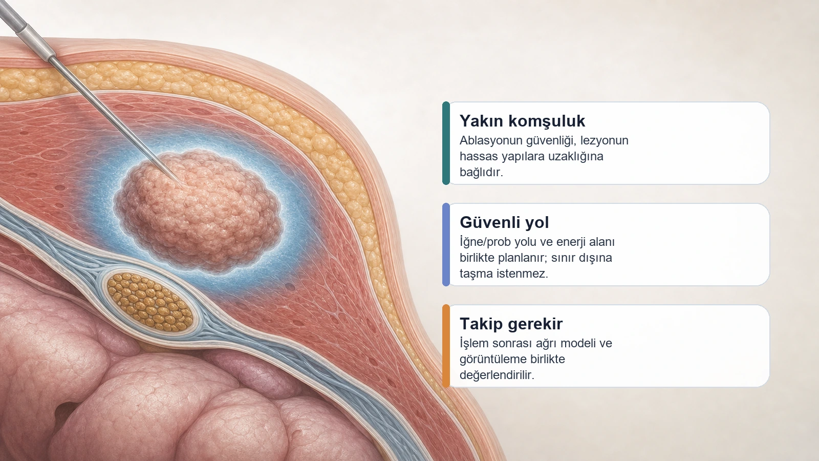 Tümör Ablasyonu Riskleri için tümör ablasyonunda yakın komşuluk, güvenli yol ve takip gereksinimini açıklayan premium medikal görsel
